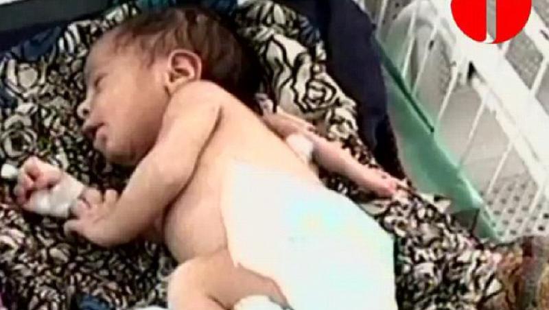 O fetita din Pakistan s-a nascut cu trei brate