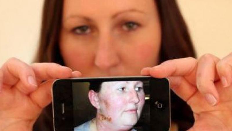 Marea Britanie: Carcasa iPhone-ului i-a cauzat unei tinere o alergie letala!