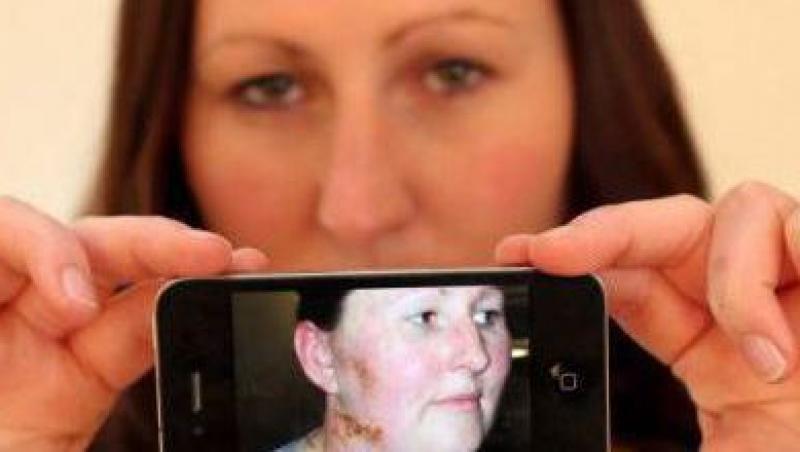 Marea Britanie: Carcasa iPhone-ului i-a cauzat unei tinere o alergie letala!