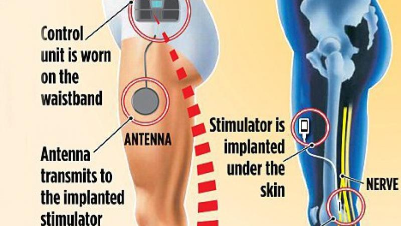 Un implant electronic le da o noua speranta persoanelor paralizate