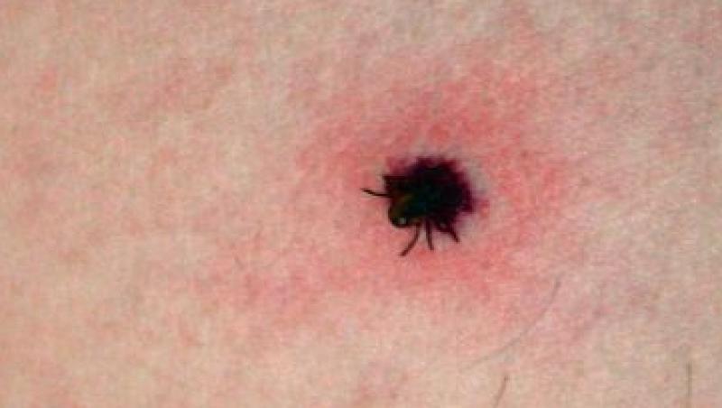 Inca trei cazuri Lyme, boala provocata de muscatura de capusa