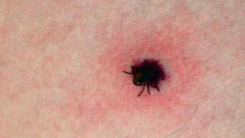 Inca trei cazuri Lyme, boala provocata de muscatura de capusa
