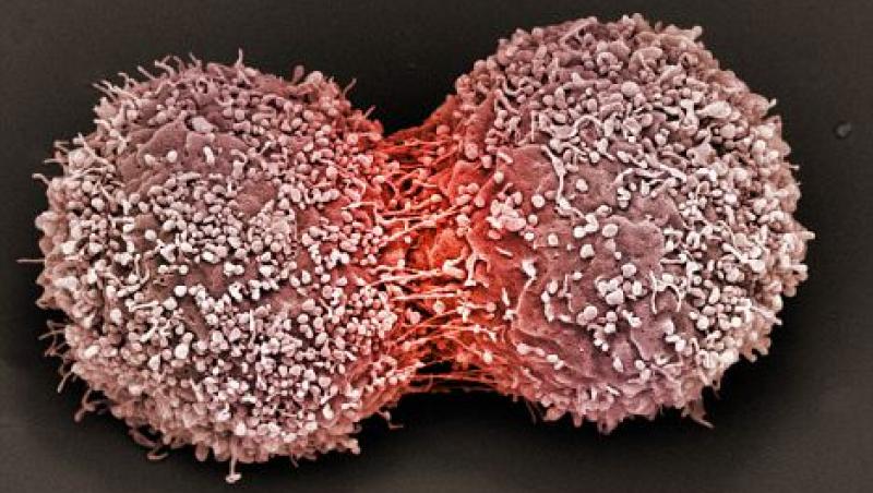 Un test genetic ar putea prezice aparita cancerului la san