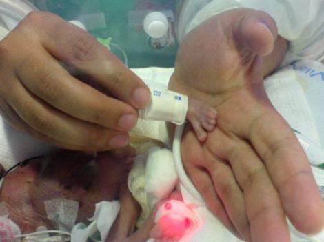 Cel mai mic bebelus din Brazilia s-a nascut cu o greutate de 340 de grame