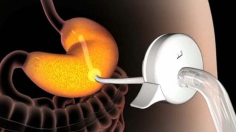 Pompa care aspira alimentele din stomac, noul tratament impotriva obezitatii