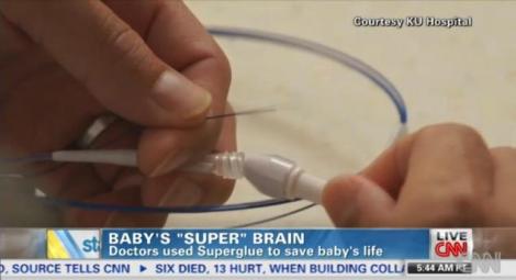Premiera mondiala: au "operat" un bebelus de trei saptamani cu Superglue!