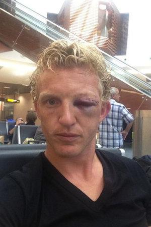 VIDEO si FOTO: Dirk Kuyt e de speriat. La propriu! Cum arata olandezul dupa ciocnirea violenta cu De Guzman