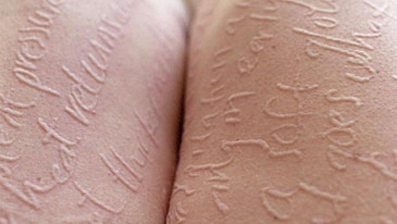 Cea mai sensibila femeie din lume: O simpla atingere ii lasa un tatuaj temporar pe corp