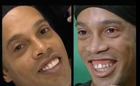 FOTO-VIDEO: Care "dintos"? Ronaldinho a investit 50.000 de euro pentru un zambet nou