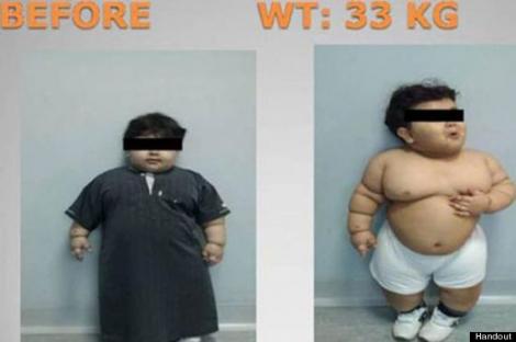 Un baietel de doi ani, cel mai tanar pacient operat impotriva obezitatii