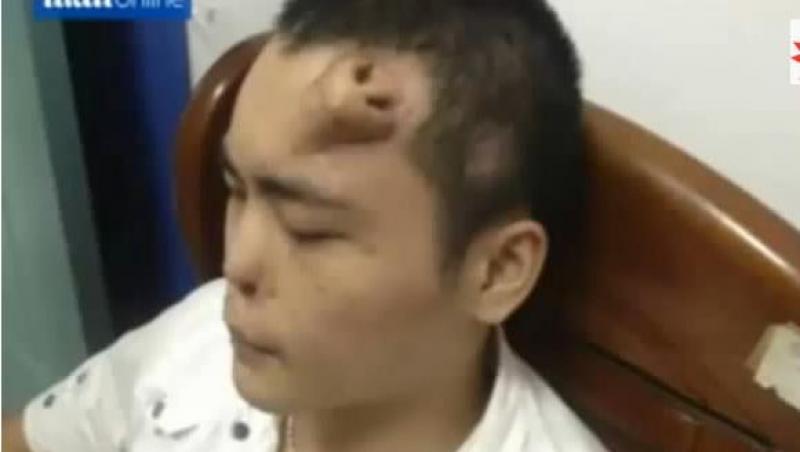 VIDEO! Unui chinez i-a crescut un nas in frunte