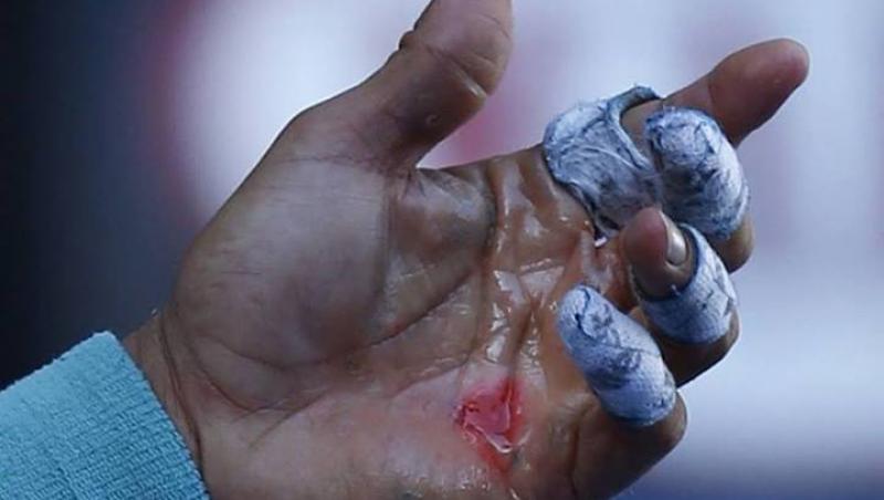 FOTO ŞOCANT! Vezi cum arată mâna lui Rafael Nadal după un meci la Australian Open