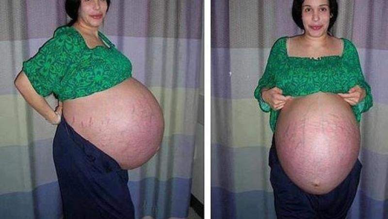 Burta cântărea cât jumătate din propria greutate! E ULUITOR cum arăta însărcinată femeia care a dat naștere a 11 bebeluși (FOTO)