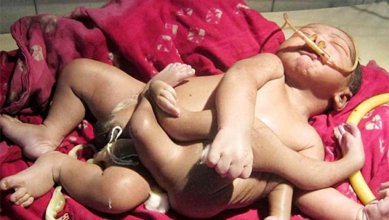 FOTO ŞOCANT: Minune dumnezeiască sau blestem teribil!? Copilul născut cu patru mâini şi patru picioare a impresionat o lume întreagă!