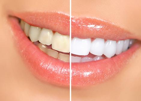 Cum să ai un zâmbet alb şi strălucitor în doar 20 de minute, fără să fie afectat smalţul dinţilor! Rezultate garantate