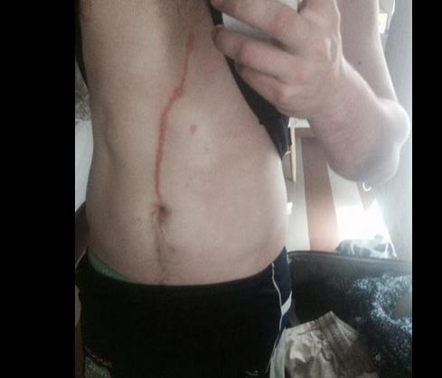 ŞOCANT! Ce au găsit medicii &icirc;n corpul unui australian i-a &icirc;ngrozit