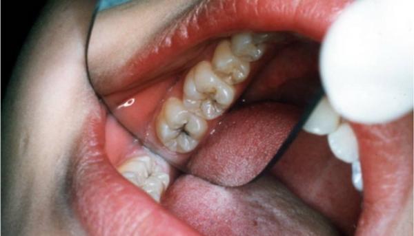 Cutremurător și &icirc;ngrijorător! O fată a murit din CAUZA UNEI CARII NETRATATE!!!