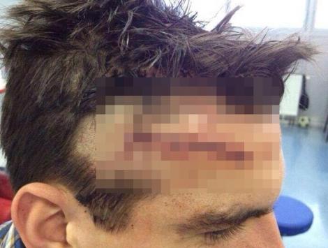 FOTO ŞOCANT! Cum arată fruntea unui fotbalist din Bundesliga după ce a fost lovit violent cu gheata