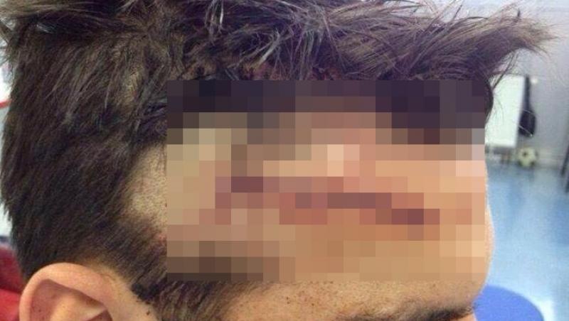 FOTO ŞOCANT! Cum arată fruntea unui fotbalist din Bundesliga după ce a fost lovit violent cu gheata