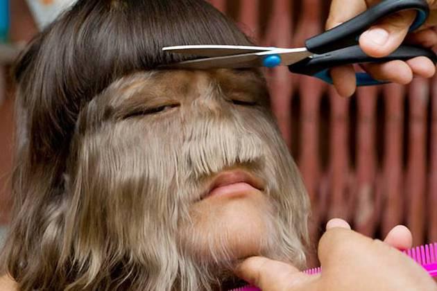 Galerie FOTO! Drama fetiţei cu chip de lup, care vrea să devină medic