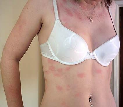 FOTO! Baia, soră cu moartea! Așa arată adolescenta alergică la APĂ