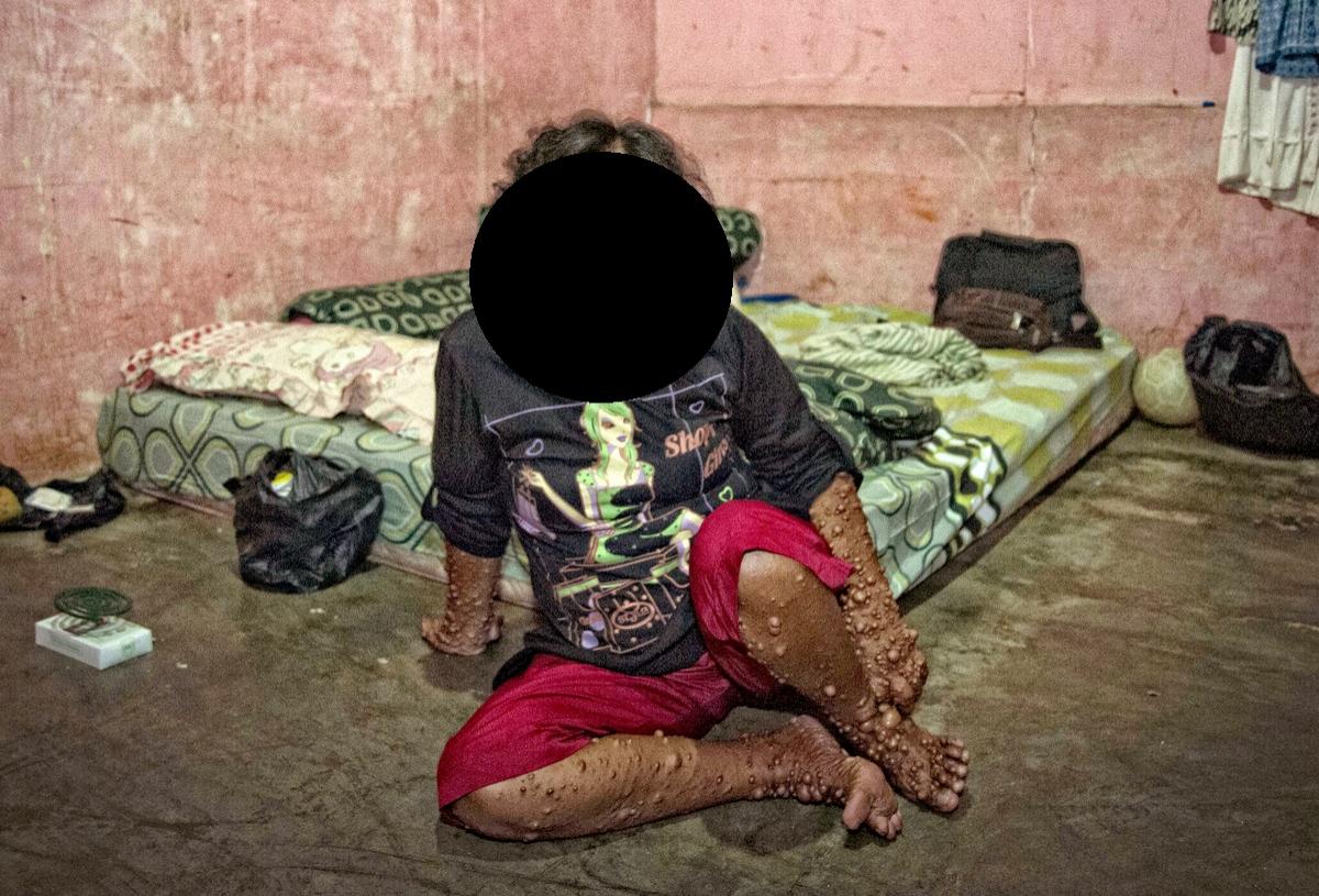 IMAGINI TULBURĂTOARE! Ea este femeia acoperită de tumori