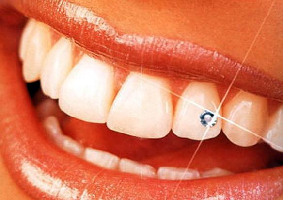 Vrei să ai cu adevărat un z&acirc;mbet de milioane?  Poftiţi la bijuterii dentare