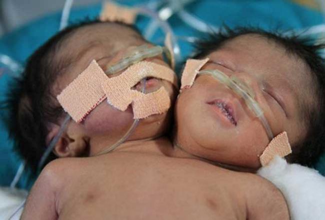 Gemenele prinse &icirc;ntr-un singur corp au murit