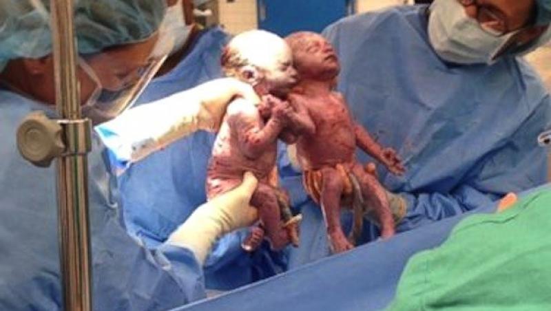 FOTO! Emoţionant: Două gemene s-au ţinut de mănă din primele clipe de viaţă