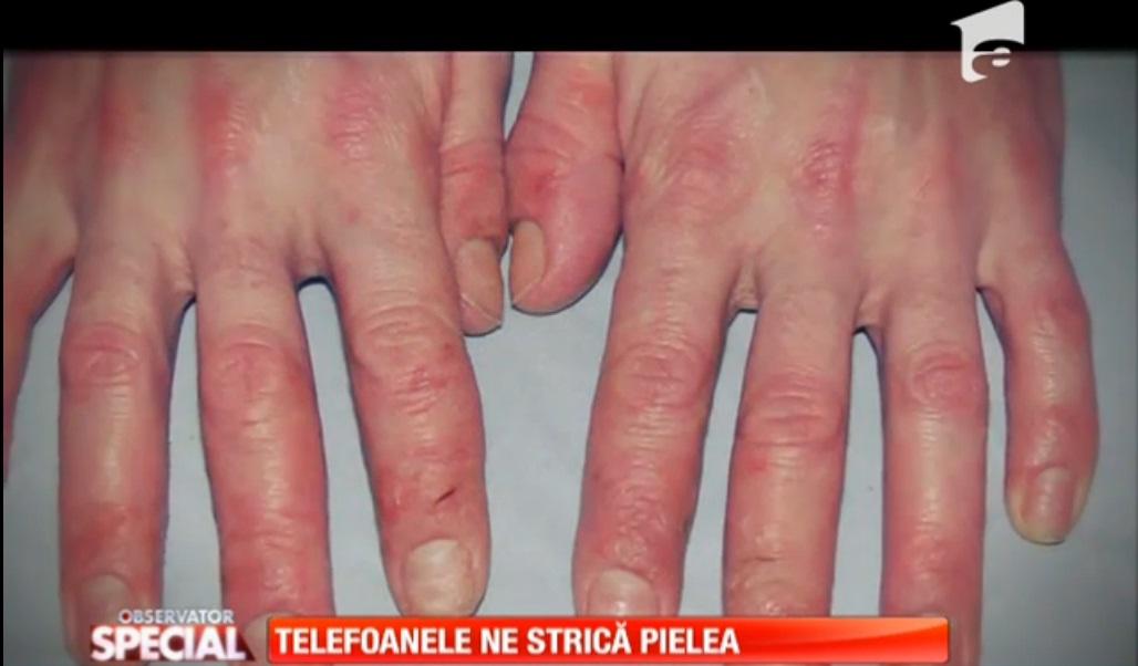 Pericol ascuns: Telefonul mobil ne poate îmbolnăvi de dermatită de contact