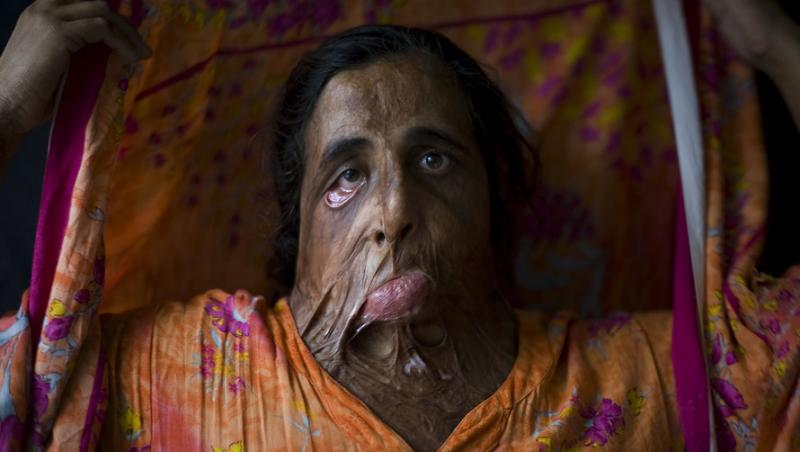 Shahnaz Bibi (35 ani) - Arsă cu acid la 25 de ani. N-a suferit nicio operaţie estetică