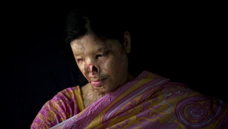 Kanwal Kayum (26 ani) - Arsă cu acid de bărbatul în faţa căruia a avut curaj să spună "NU"