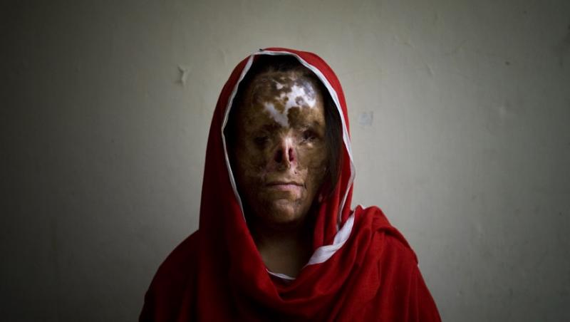 Najaf Sultana (16 ani) - Arsă de tatăl ei, pe când avea 5 ani. Bărbatul era supărat că are prea multe fete