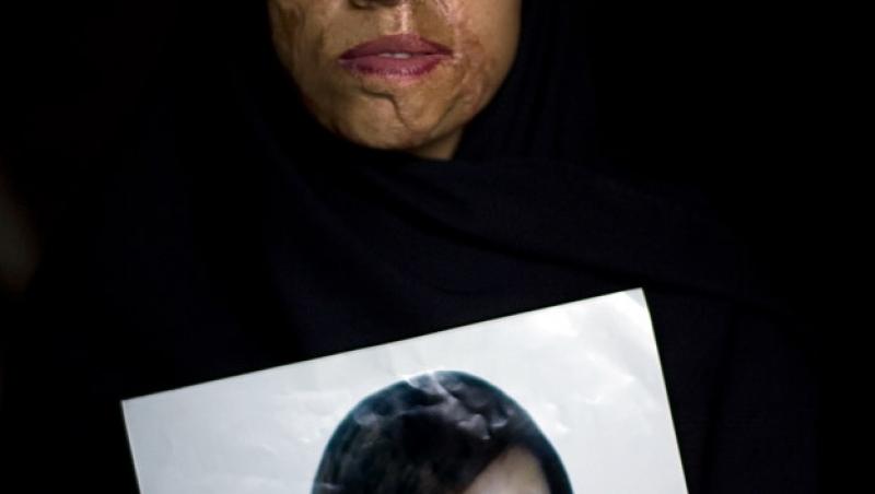 Saira Liaqat (26 ani) - Şi-a dat acceptul, dar iubitul a ars-o cu acid pentru că a ezitat să se mute împreună