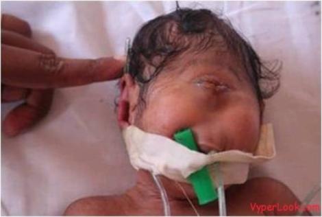 Imagini ȘOCANTE! Bebelușul CICLOP: S-a născut cu un singur ochi