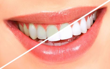 Dinți albi în doar 3 minute! Află cum poți face asta cu 3 ingrediente ieftine