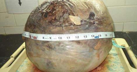 De dimensiunea unui pepene de 15 kilograme - cea mai mare TUMOARE din lume îndepărtată din uterul unei femei