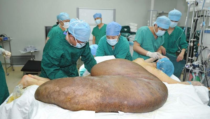 Cea mai mare tumoare din lume: 110 kilograme