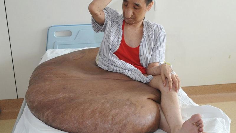 Cea mai mare tumoare din lume: 110 kilograme