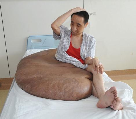 Imagini ŞOCANTE! Cea mai mare tumoarea din lume, de 110 kilograme, a chinuit un chinez timp de 37 de ani