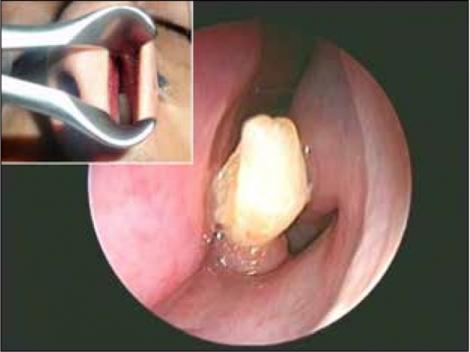 Medicii au rămas ȘOCAȚI: Au descoperit un dinte crescut în nasul unui pacient!