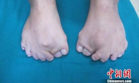 Imagini uluitoare! Cum arată fetița care s-a născut cu 15 degete la fiecare picior: "Îmi e greu să găsesc încălțăminte"