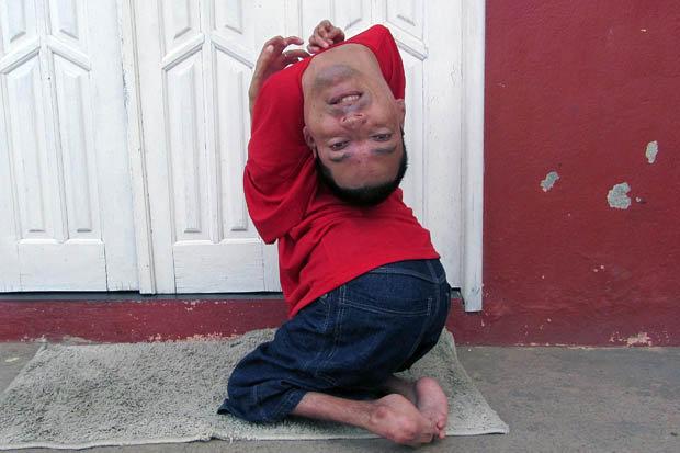 IMAGINI CU PUTERNIC IMPACT! "Nu-l mai hrăniţi, oricum MOARE" L-au tratat ca un animal, dar a rezistat! El e omul care nu-şi ţine capul pe umeri