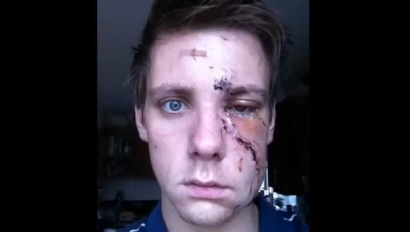 Și-a documentat recuperarea după operație cu un clip făcut din selfie-uri: Iată ce a ieșit!