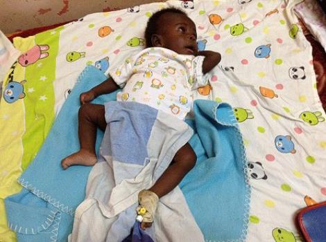 Băiatul care s-a născut cu patru mâini și patru picioare a fost operat: Uite cum arăta înainte de intervenție și cum este acum!