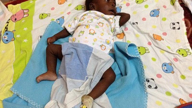 Băiatul care s-a născut cu patru mâini și patru picioare a fost operat: Uite cum arăta înainte de intervenție și cum este acum!