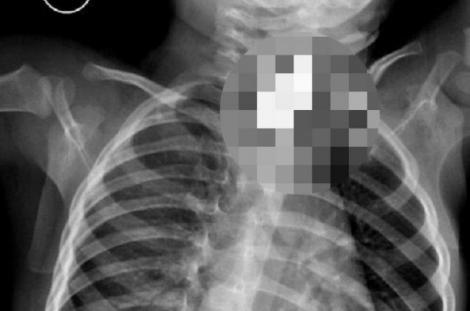 ŞOCANT! Ce au descoperit în corpul unui copil de 16 luni! Radiografia i-a speriat până și pe medici