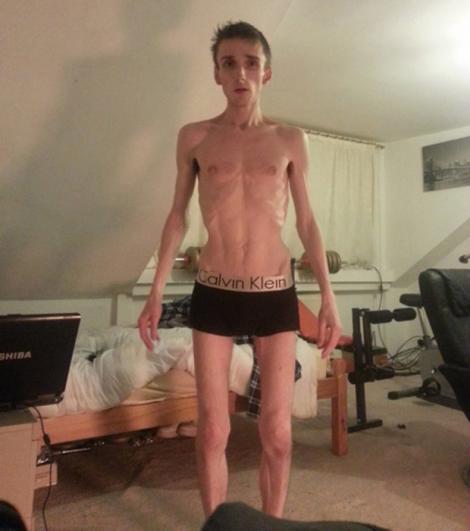 Toți se îngrozeau când îl vedeau, acum nu își pot lua ochii de el! Transformarea incredibilă a unui tânăr anorexic i-a uimit pe toți!