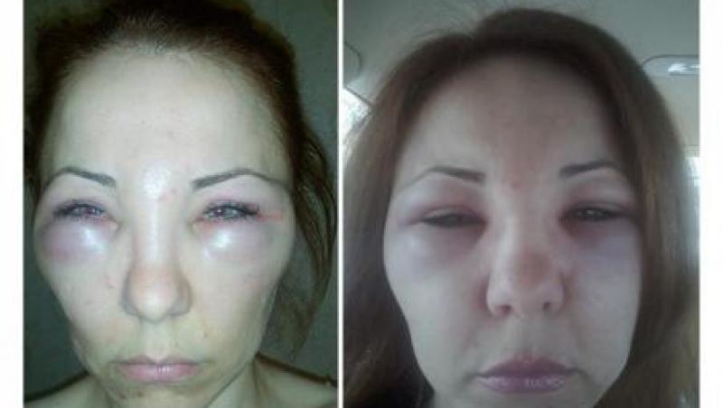 Imagini ȘOCANTE! Cum a ajuns să arate o avocată din Alba Iulia, după ce medicul estetician i-a injectat VENIN în loc de botox