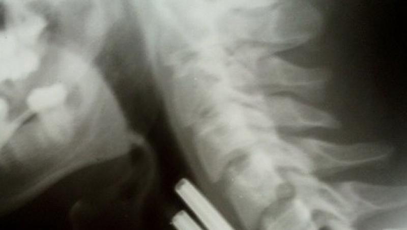 FOTO: Doctorii s-au îngrozit când au văzut ce se află în GÂTUL unui bărbat! L-au operat de urgență! ”În câteva de minute murea”